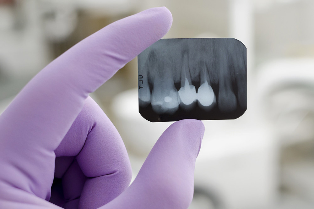 Endodontics: the importance of preserving our teeth