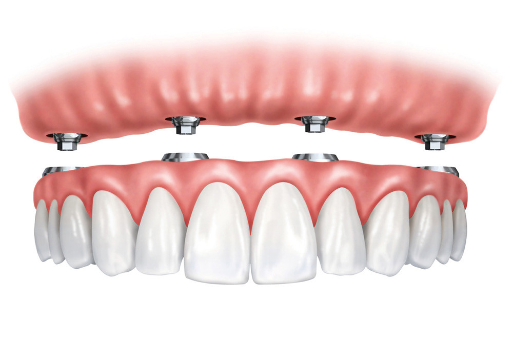 Implantology for the edentulous patient: simplified protocols