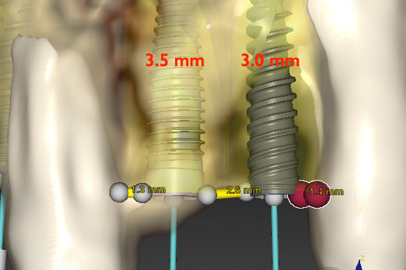 Il valore della pianificazione protesica in terapia implantare