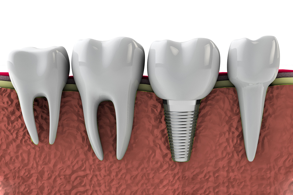 Periimplantitis … what it is and how can we defend ourselves