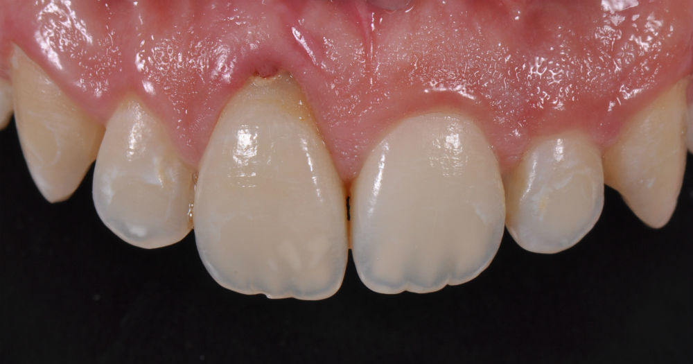 Prosthetic treatments on osseointegrated implants - Studio Dentistico ...